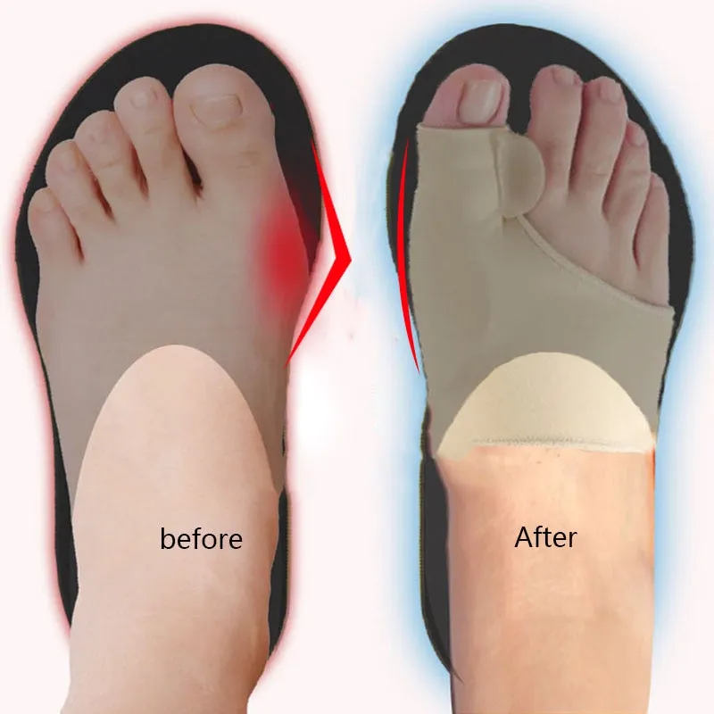 Hallux Valgus Bunion Orthotic Corrector